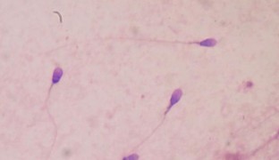 El microbioma del semen influye en la transmisión sexual del VIH